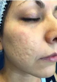 Three-quarter view of a woman’s cheek before treatment, showing pitted rolling scarring across the cheek
