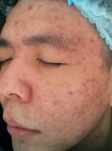 Three-quarter view of a man’s face before treatment, showing dense papules across the cheek, forehead and jaw with redness between them