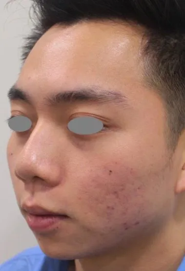 The same three-quarter view after treatment, with the cysts resolved and the marks fading