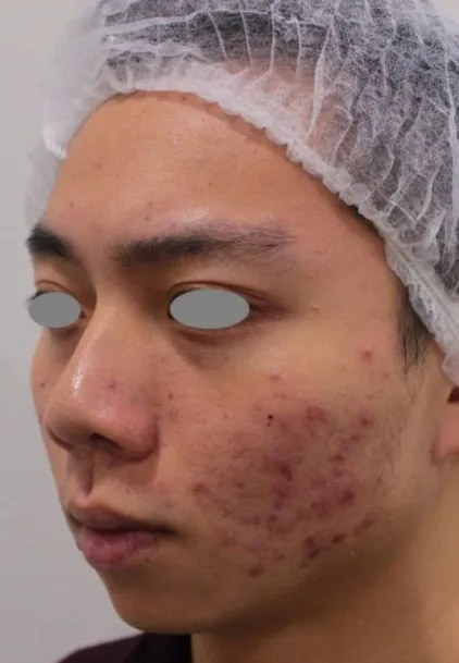 Three-quarter view of a young man’s face before treatment, showing inflamed cystic lesions along the lower cheek and jaw over dark marks