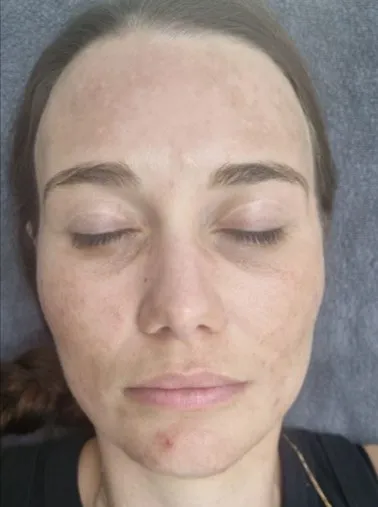 The same front view after treatment, with the face clear and the tone even