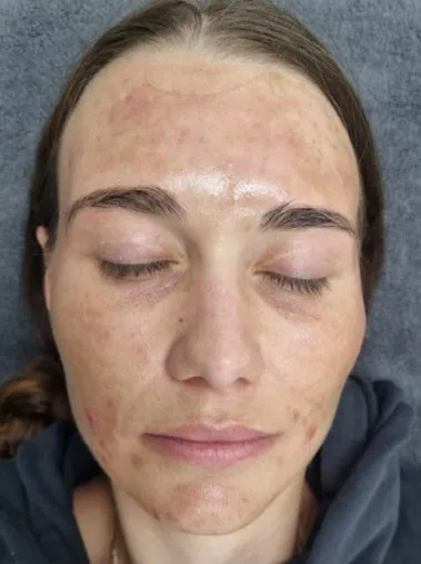 Front view of a woman’s face before treatment, showing spots and red marks across the forehead, cheeks and chin