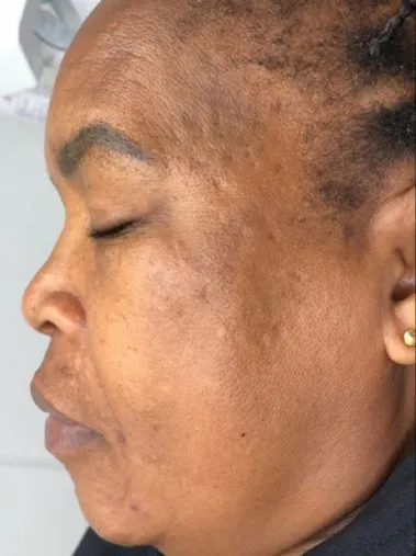 The same side view after treatment, with the marks lifted and the tone more even
