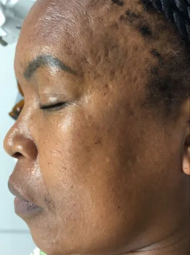 Side view of a woman’s face before treatment, showing dark post-acne marks along the jawline and over the temple
