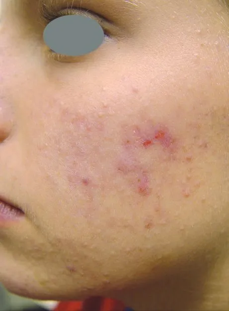 Close-up of a young woman’s cheek before treatment, showing a cluster of inflamed cystic lesions with redness around them