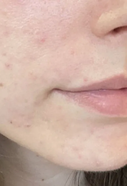 The same close-up after treatment, with the nodules resolved and the skin flat