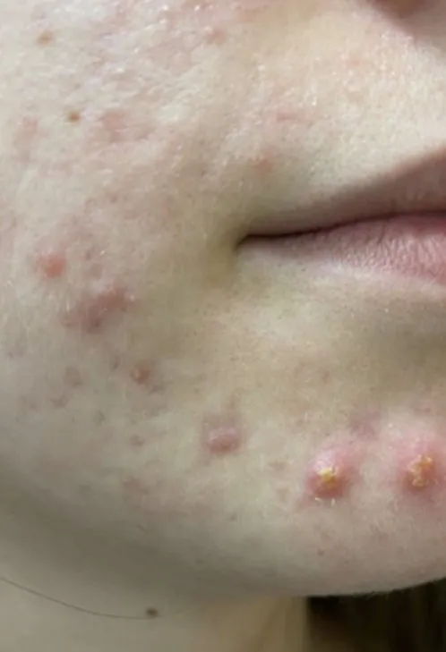 Close-up of a young woman’s lower cheek and jaw before treatment, showing raised inflamed nodules