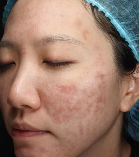 Three-quarter view of a woman’s cheek before treatment, showing red papules and marks spread over the cheek and temple