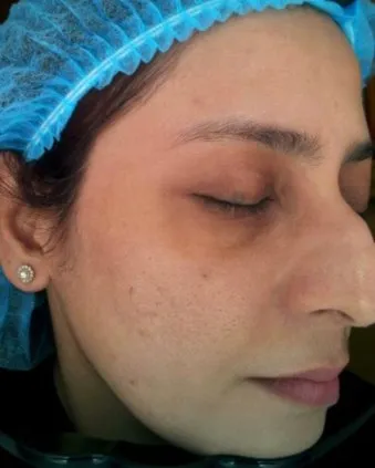 The same three-quarter view after treatment, with the redness calmed and the marks faded