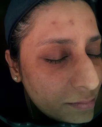 Three-quarter view of a woman’s face before treatment, showing redness across the cheek with acne marks through it