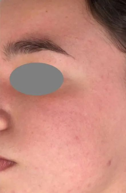 The same close-up after treatment, with the surface smoother and the marks lifted