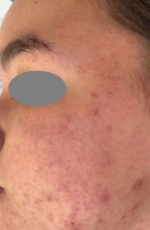 Close-up of a cheek and temple before treatment, showing dense small pitted scars with dark marks between them