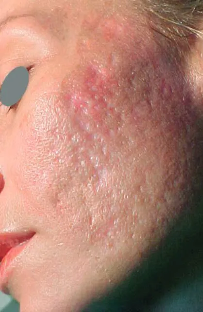 Close-up of a cheek before treatment, showing deep red-purple inflamed scarring, raised and uneven