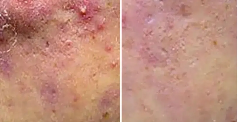 Active Acne Treatment before and after: the same person before treatment on the left and after treatment on the right, case 1. Results may vary.