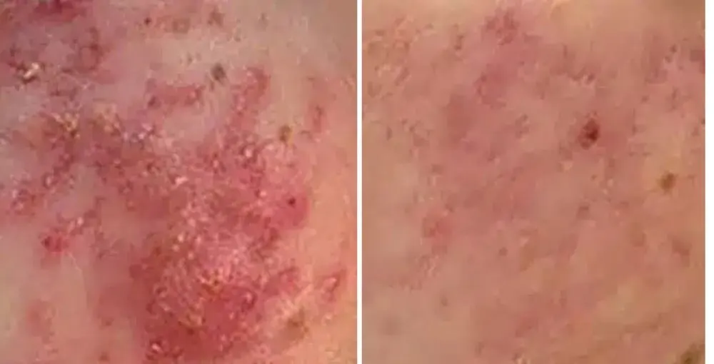 Active Acne Treatment before and after: the same person before treatment on the left and after treatment on the right, case 3. Results may vary.