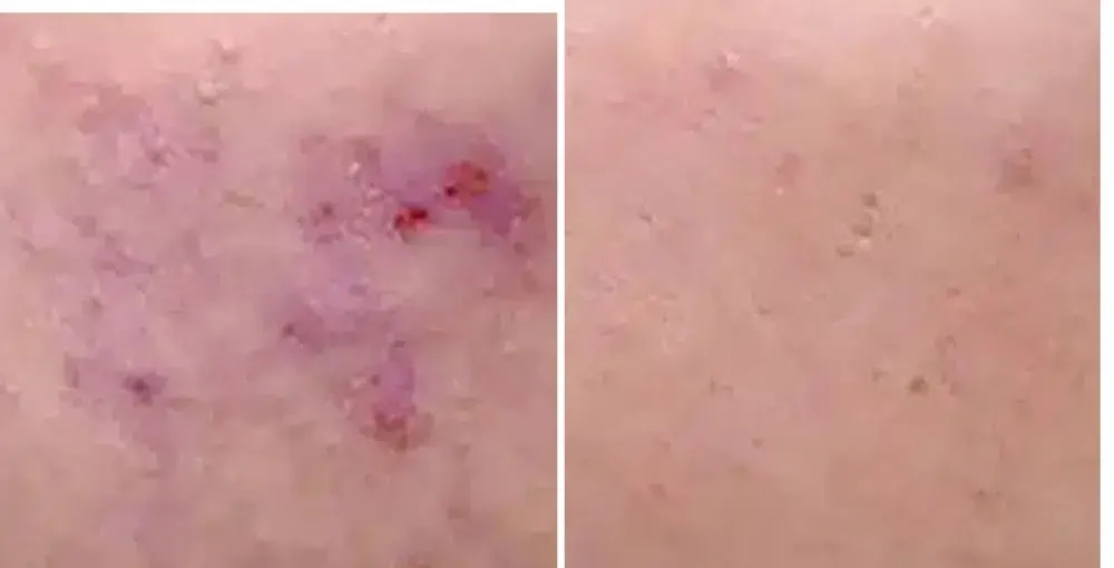 Active Acne Treatment before and after: the same person before treatment on the left and after treatment on the right, case 4. Results may vary.