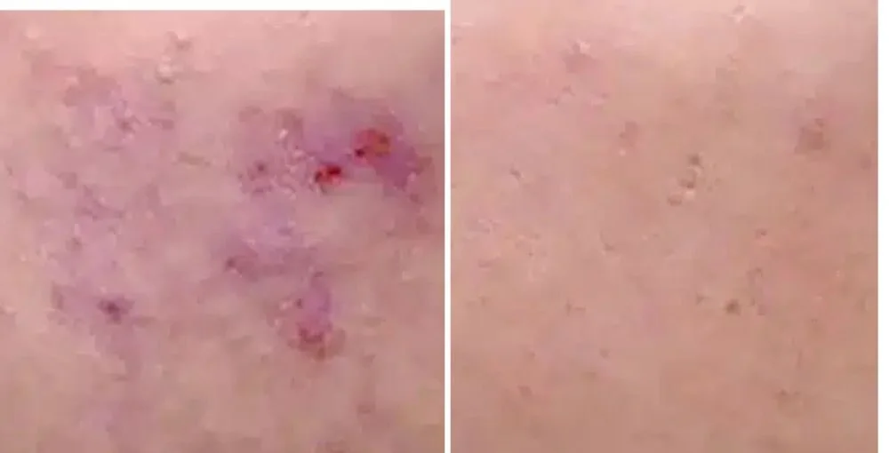 Active Acne Treatment before and after, enlarged: the same person before treatment on the left and after treatment on the right, case 4. Results may vary.