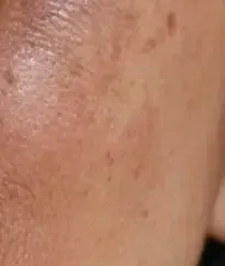 Close-up of brown pigment spots on a cheek before BBL HEROic treatment at Medrein Health in Southlake, TX