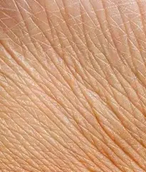 Close-up of fine lines and crepey wrinkling in the skin, a concern treated with BBL HEROic in Southlake, TX