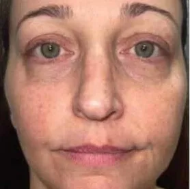 Front view of a woman before BBL HEROic, showing shadowing under both eyes and redness spreading across the cheeks and nose