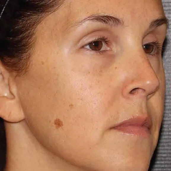 Three-quarter view of a woman before BBL HEROic, showing one dark brown spot on the cheek and scattered sun freckling