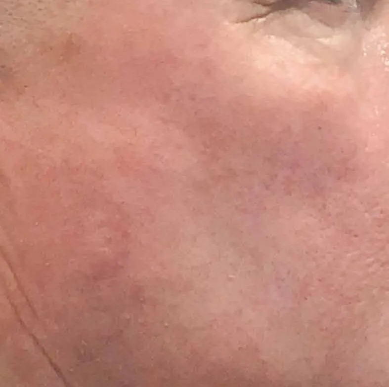The same cheek close-up after BBL HEROic, with the redness settled and the fine vessels far less visible