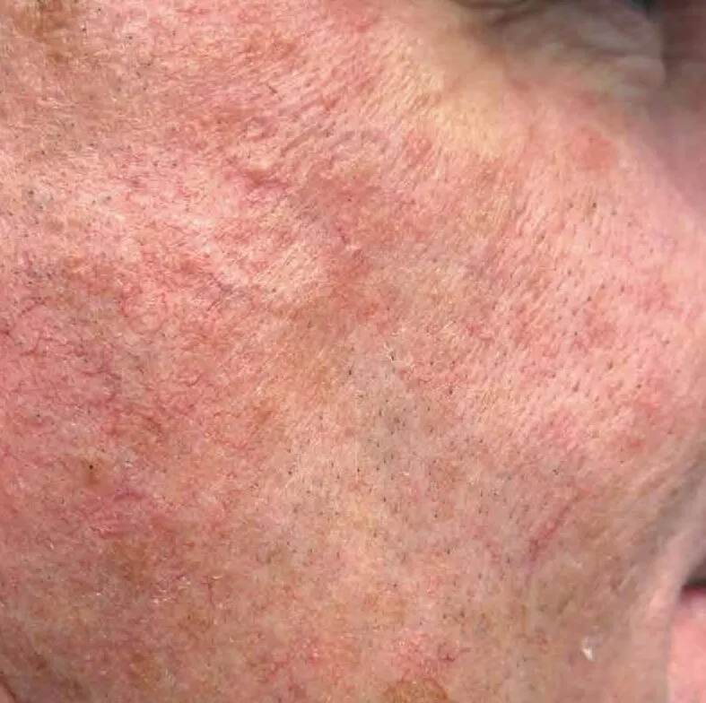 Close-up of a cheek before BBL HEROic, showing widespread redness and fine broken capillaries