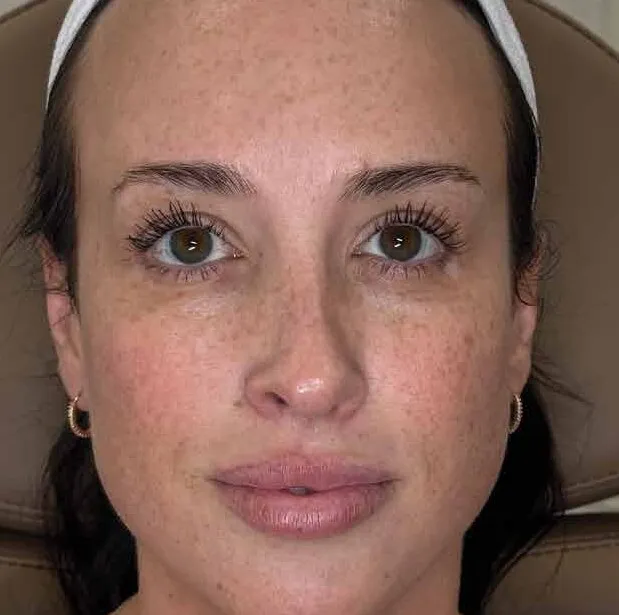 Front view of a woman before BBL HEROic, showing freckling and sun spots across the cheeks and nose over a flushed base