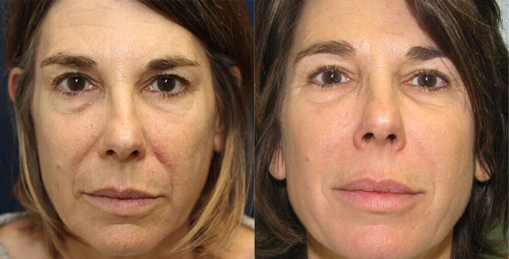 Bellafill before and after, enlarged: the same person before treatment on the left and after treatment on the right, case 1. Results may vary.