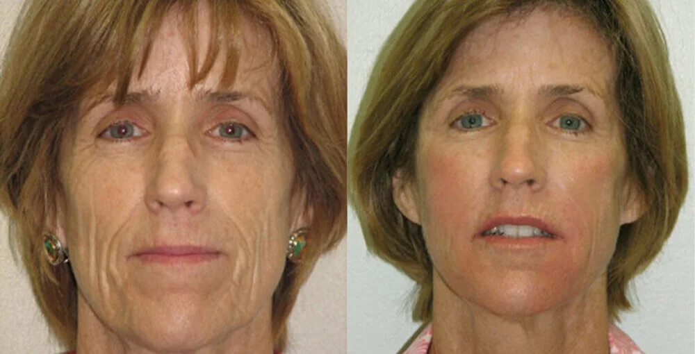 Bellafill before and after, enlarged: the same person before treatment on the left and after treatment on the right, case 3. Results may vary.