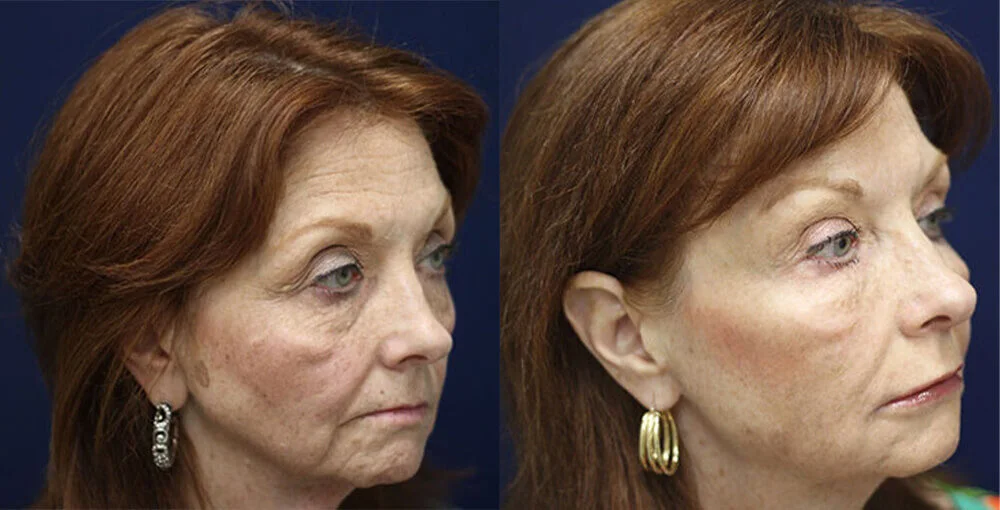Bellafill before and after, enlarged: the same person before treatment on the left and after treatment on the right, case 4. Results may vary.