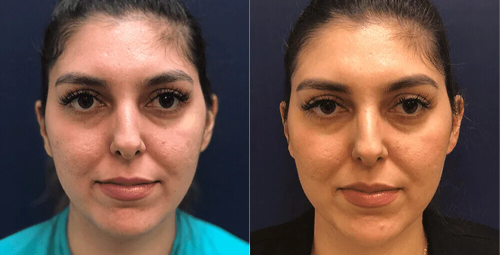 Bellafill before and after, enlarged: the same person before treatment on the left and after treatment on the right, case 5. Results may vary.