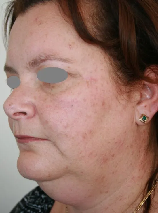 The same three-quarter view after benign lesion removal, with the raised lesions gone