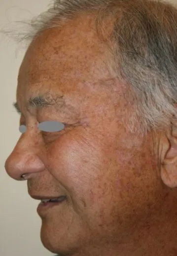 The same three-quarter view after benign lesion removal, with the temple and brow clear