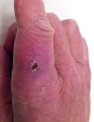 The same finger later, the wound closed to a small central mark with the surrounding skin intact