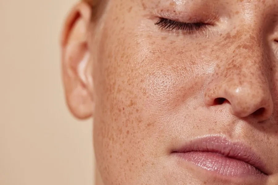 A close-up of freckles and sun spots scattered across a woman's cheek and nose, the defined pigment a Picolaser can target