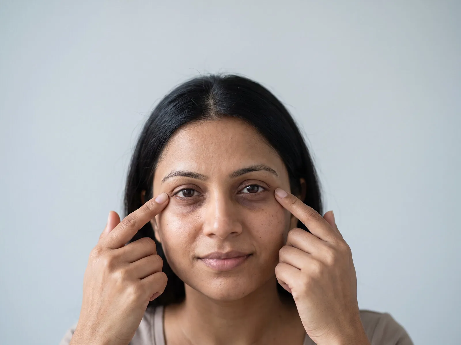 Close view of a tear-trough hollow beneath a woman's eye, the structural cause of under-eye darkness that a pigment laser does not treat