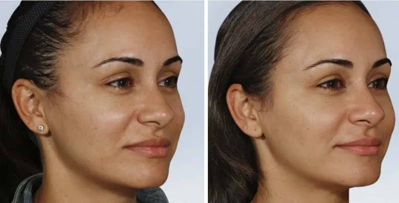 Sculptra Before & After: How Long Does It Last?