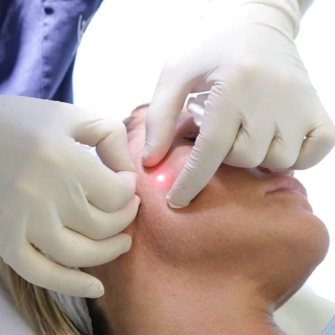 Gloved hands guiding an ultra-fine single-use optical laser fiber beneath the skin at a patient's jawline during an EndoTight treatment, with the laser tip glowing under the skin