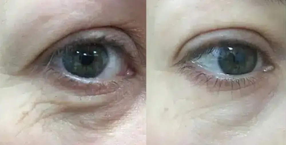 Eyelase before and after: the same person before treatment on the left and after treatment on the right, case 3. Results may vary.