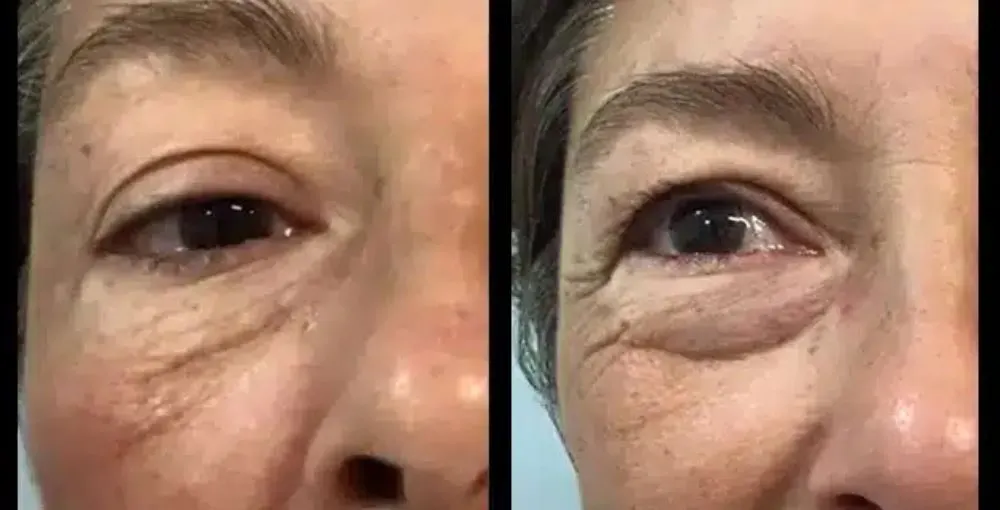 Eyelase before and after: the same person before treatment on the left and after treatment on the right, case 4. Results may vary.