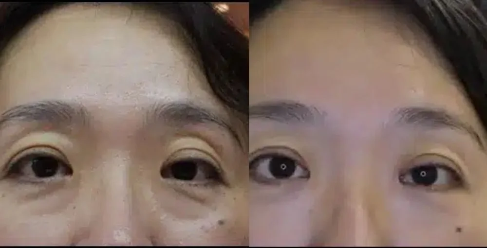 Eyelase before and after, enlarged: the same person before treatment on the left and after treatment on the right, case 5. Results may vary.