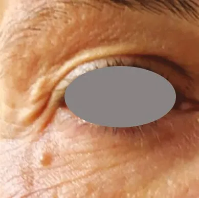 Close three-quarter view of one eye before treatment, with a deep fan of lines at the outer corner and loose creasing across the upper lid