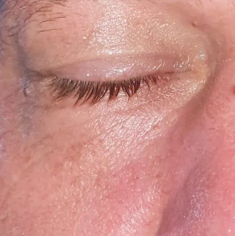 The same closed eye after treatment, with the outer-corner lines fainter and the skin below the lid reading smoother
