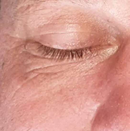 Close view of a closed eye before treatment, with fine lines at the outer corner and crepey texture on the skin below the lower lid