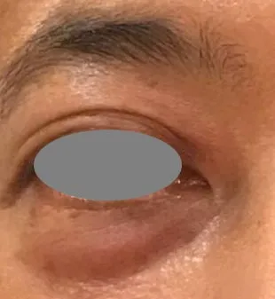 The same under-eye area after treatment, with the pouch flatter and the line where it met the cheek less defined
