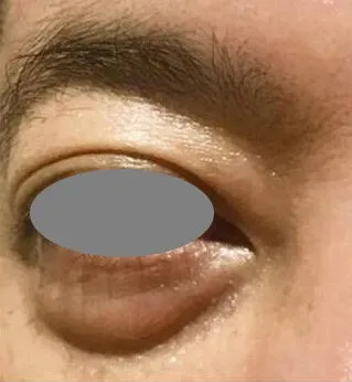 Close view of the under-eye area before treatment, with a full pouch below the lower lid casting a shadow line onto the cheek