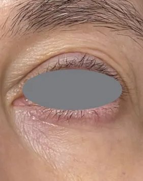 The same lower lid after treatment, with the skin under the lash line reading smoother and more even