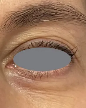Close view of the lower lid before treatment, with crepey skin and fine lines gathered under the lash line