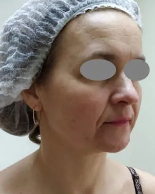 Three-quarter view of a woman’s lower face before a Fotona 4D facelift, showing a slack lower cheek and a line running from the mouth corner toward the jaw